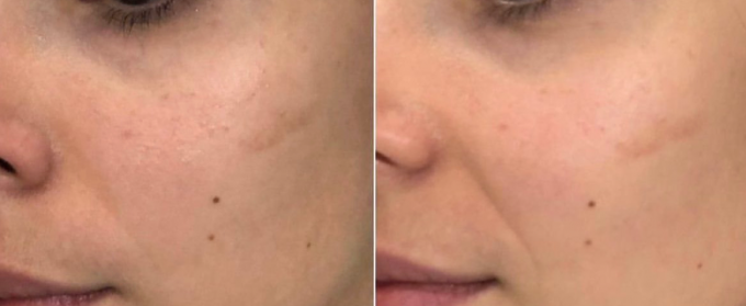 Anti-Age Mesotherapy service image