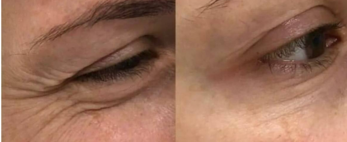 Botulinum Toxin Therapy service image
