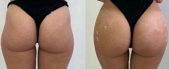 Buttocks Shape Augmentation service image