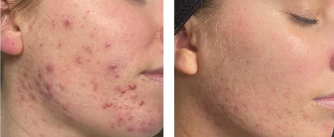 Facial with NUJEVI service image