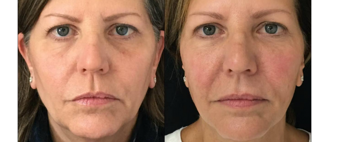 Filler Facial Contouring service image