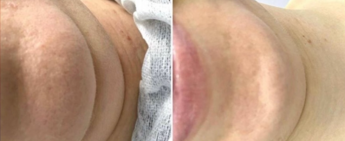 Lipolysis Injection service image