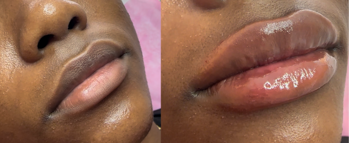 Lips Augmentation PROMO service image
