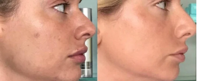 Microneedling service image