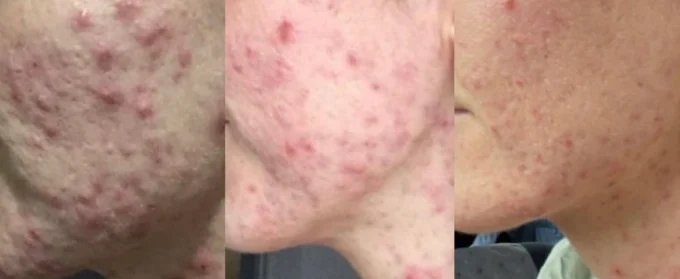PRP - Plasma Therapy / Vampire Facial service image