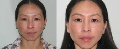 Skin Peeling service image
